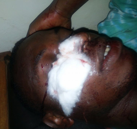 Kelly Mukwano, injured by a mob (Photo courtesy O-blog-dee-o-blog-da)
