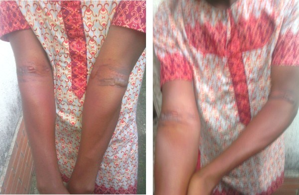 Nigerian victim of anti-gay kidnapping and blackmail shows the marks on his arms where he was tied up. (Photos courtesy of NoStrings)